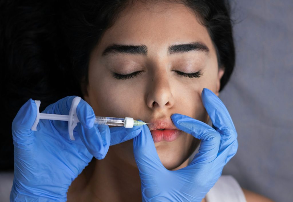 Les lèvres reçoivent une injection de produit de comblement.
